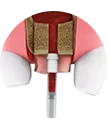 Complete resorption